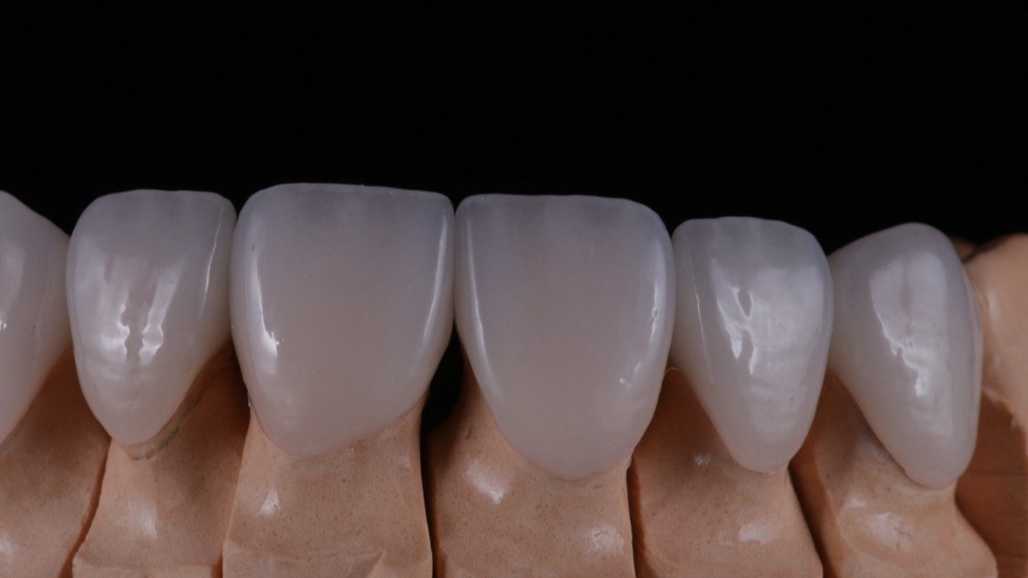 Виниры из пресс-керамики: Композитные виниры Алматы для идеальной улыбки в Smart Lab.