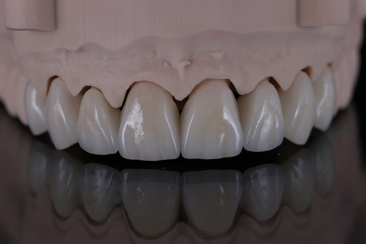 Пресс-керамика JC LISY: Виниры на зубы Алматы из пресс-керамики для высокой эстетики.