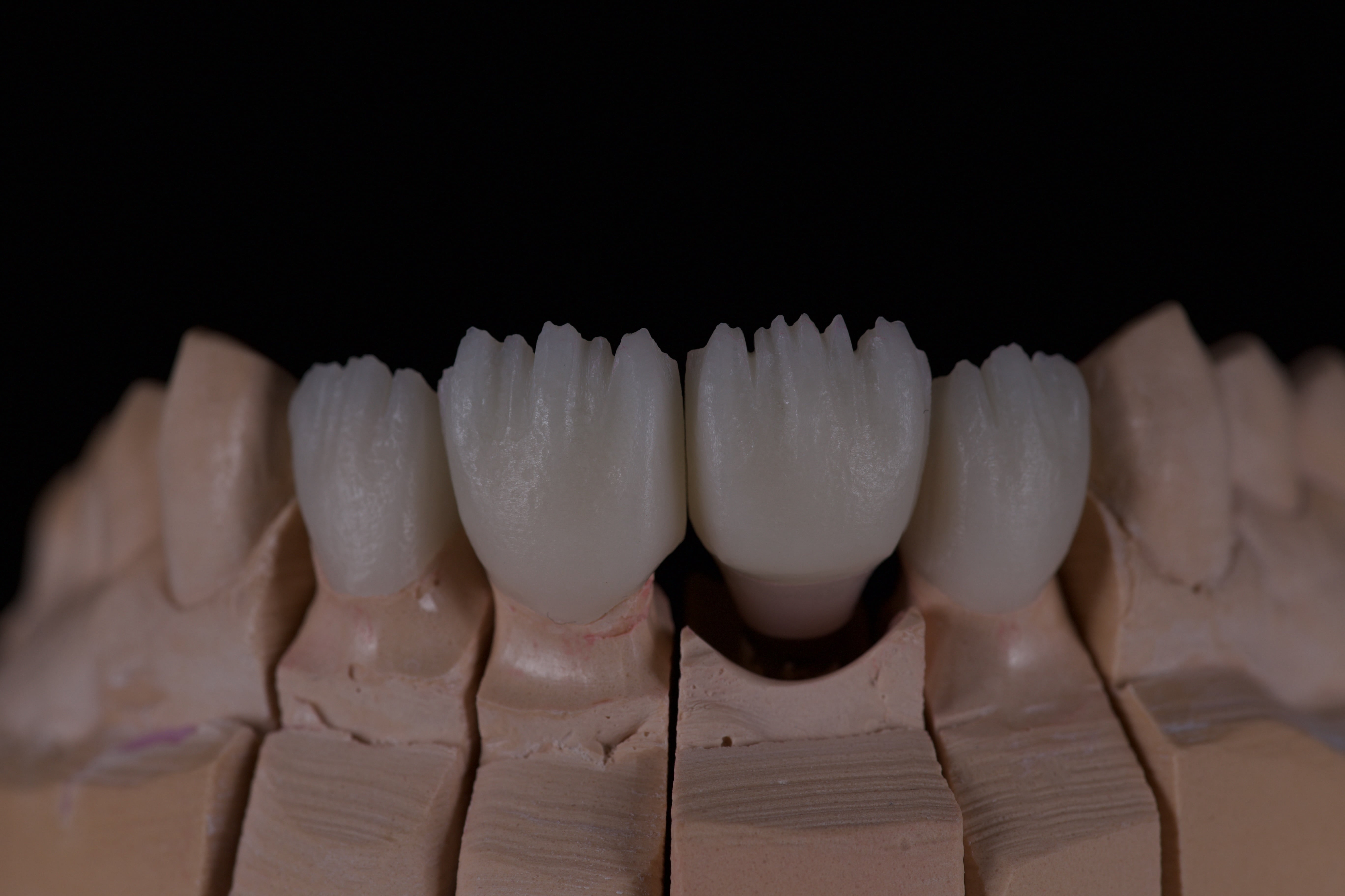 Эстетические коронки: Коронки e.max Алматы для естественного вида в лаборатории по металлокерамике.