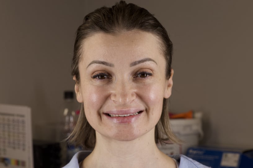 Зубные мосты: Изготовление зубных мостов на имплантах в зуботехнической лаборатории Алматы.