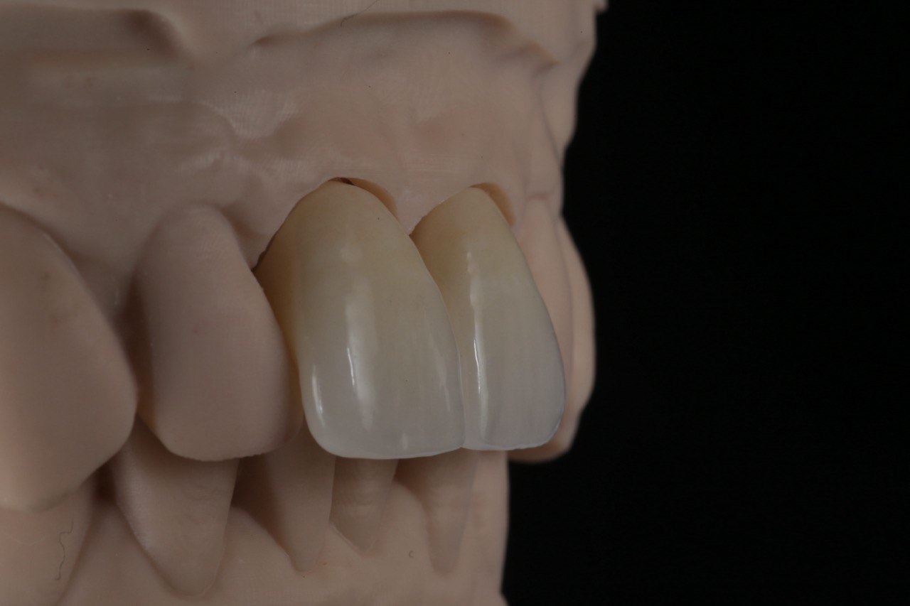 Циркониевые коронки: Эстетические коронки Алматы из диоксида циркония для долговечного протезирования.