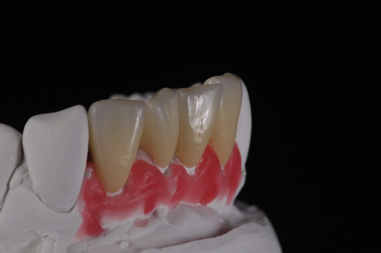 Повторение природной анатомии: Циркониевые коронки Алматы с естественной анатомией в лаборатории CAD/CAM.