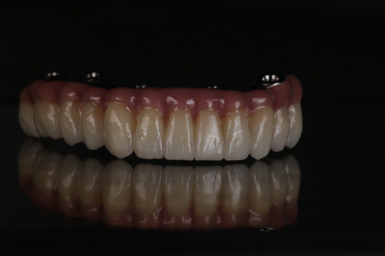 Протоколы FP1, FP2, FP3: Съемные протезы Алматы с использованием современных технологий протезирования.