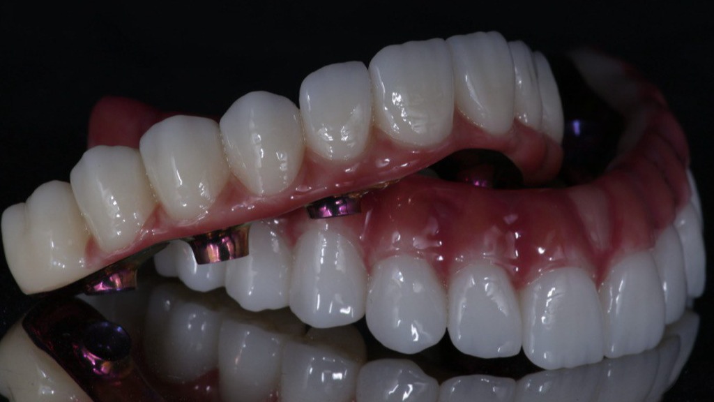 All in 4/6: Условно-съемные циркониевые протезы Казахстан в лаборатории CAD/CAM Алматы.