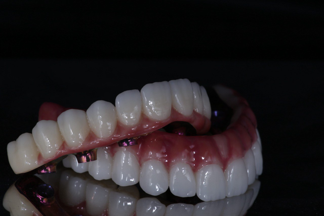 All in 4/6: Зубные мосты на имплантах для тотальной реабилитации в лаборатории протезирования Алматы.