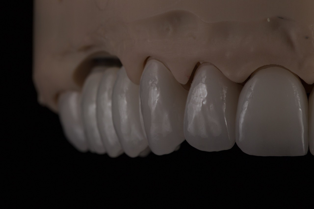 Мостовидный протез: Изготовление мостов Алматы с высокой эстетикой в лаборатории по цирконию.