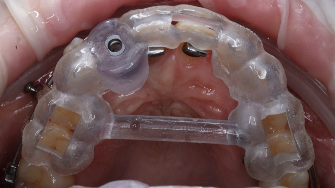 Хирургические шаблоны: Стоматологический 3D принтинг для точных шаблонов в лаборатории Алматы.