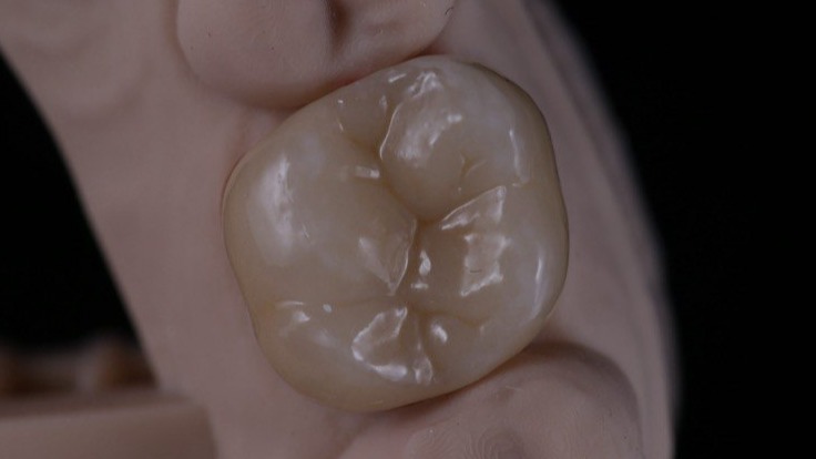 Цирконий в полную анатомию: Фрезеровка циркония Алматы для коронок в полной анатомии.